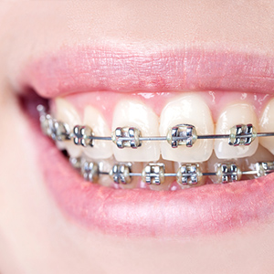 metal braces